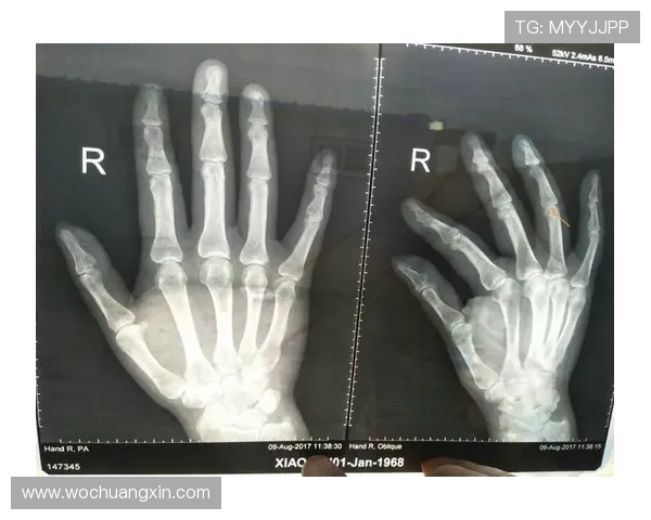 森林狼宣布莱昂纳德米勒右手小拇指受伤两周后将进行复查